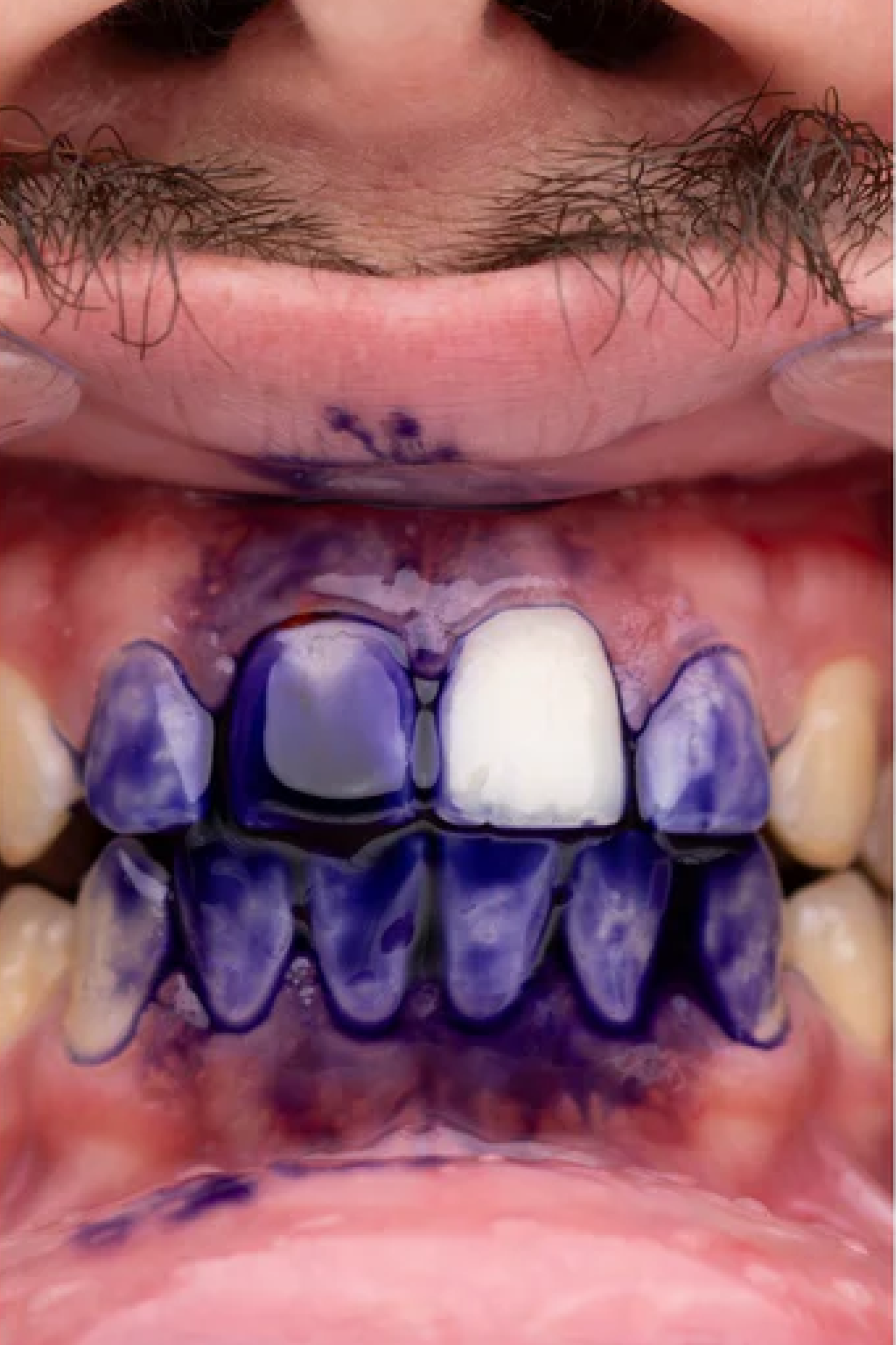 ROXO V34 - Branqueamento Dentário