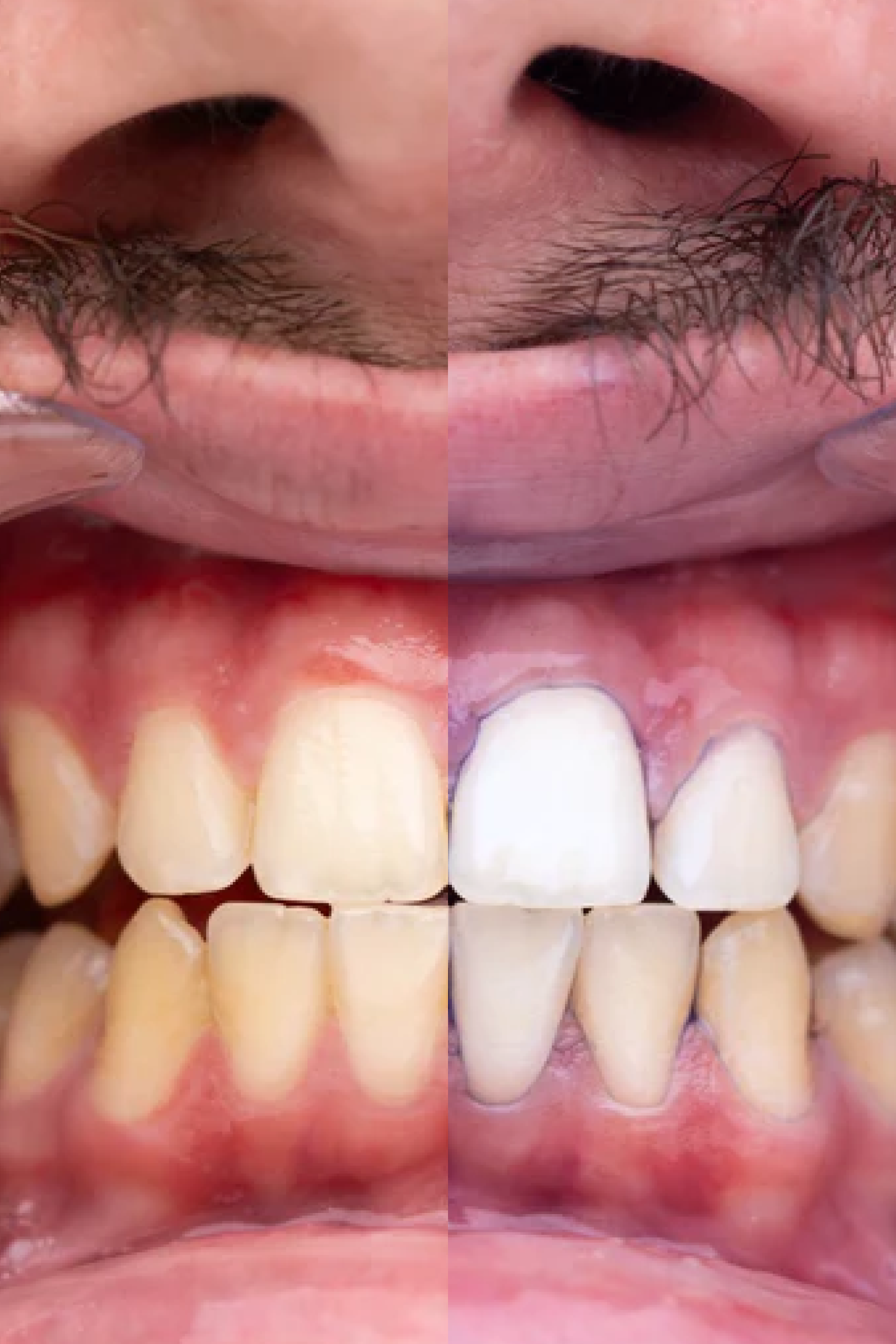 ROXO V34 - Branqueamento Dentário