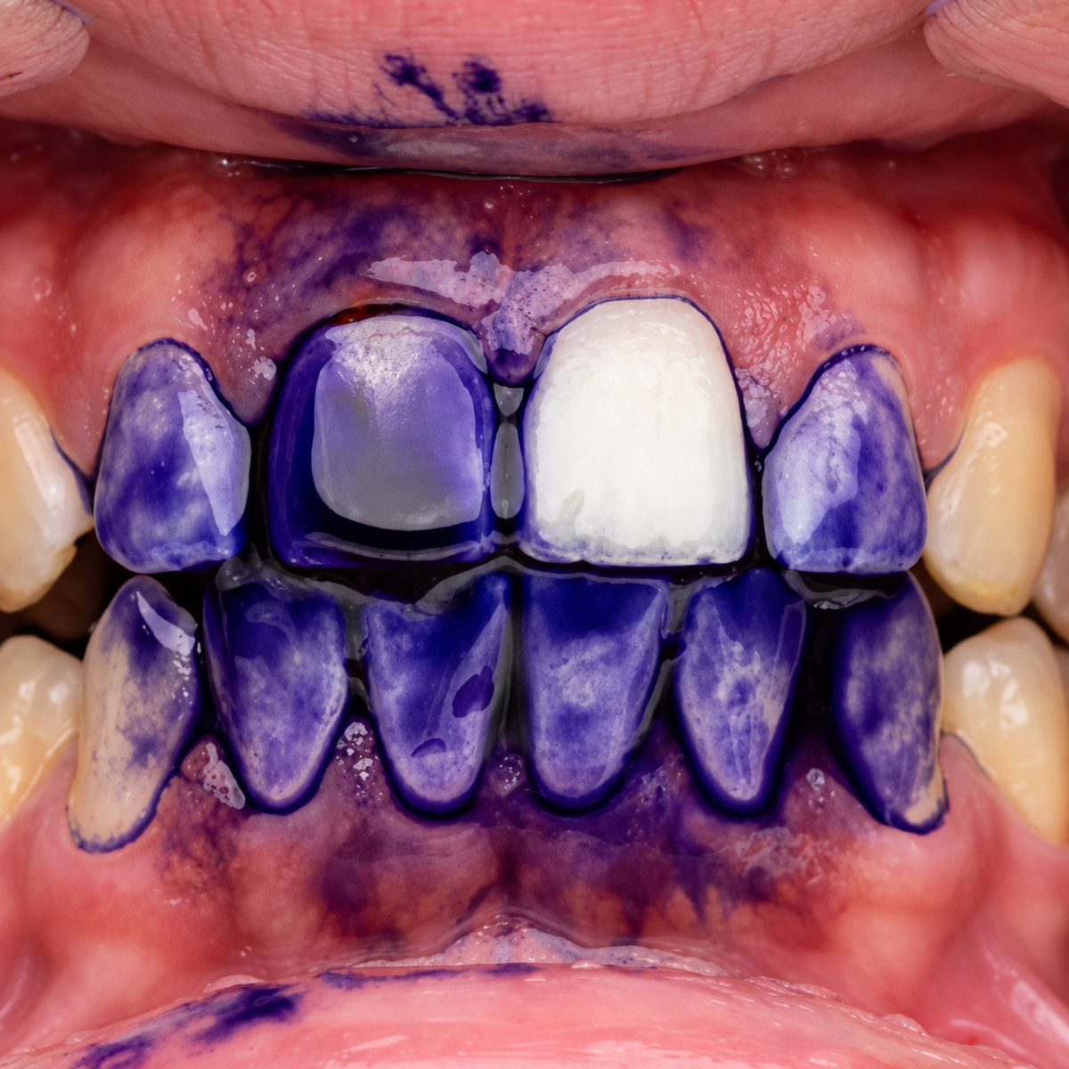 Dientes cubiertos con el gel Purple V34 durante la aplicación